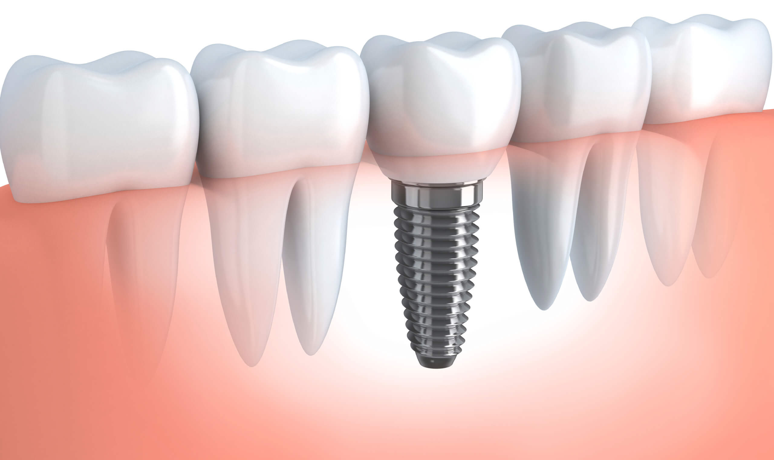Dental Implants Scarborough